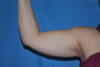 Liposuction case #4609