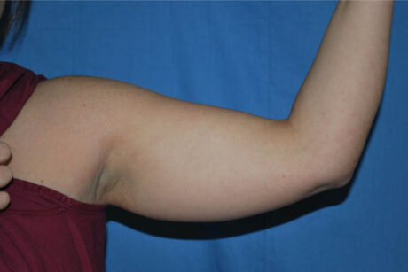 Liposuction case #4609