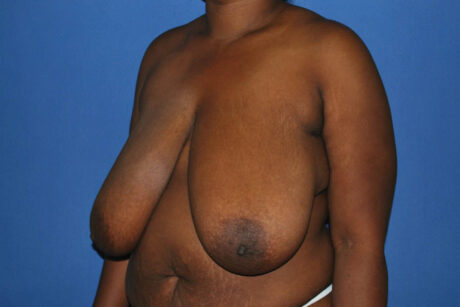 Breast Reduction case #4133