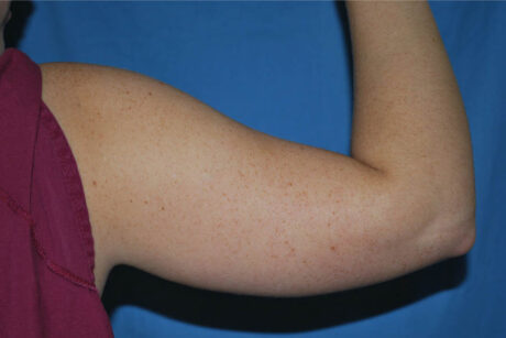 Liposuction case #4609