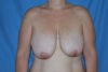 Breast Reduction case #4144