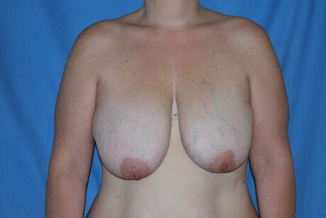 Breast Reduction case #4144