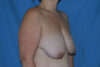 Breast Reduction case #4144