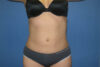 Liposuction case #4618