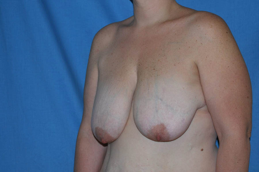 Breast Reduction case #4144