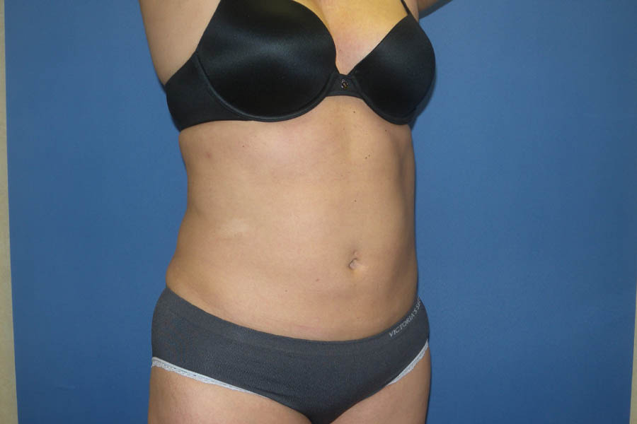 Liposuction case #4618