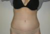 Mommy Makeover case #5506