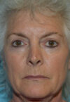 Neck Lift case #5070