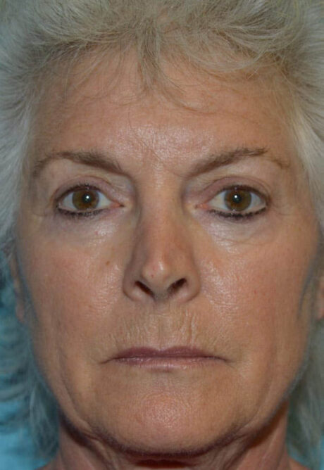 Neck Lift case #5070