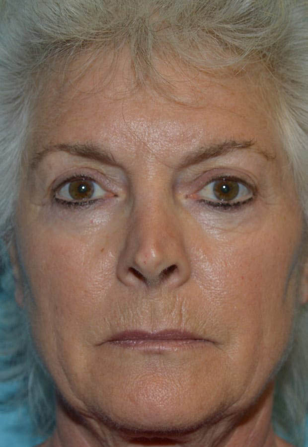Neck Lift case #5070