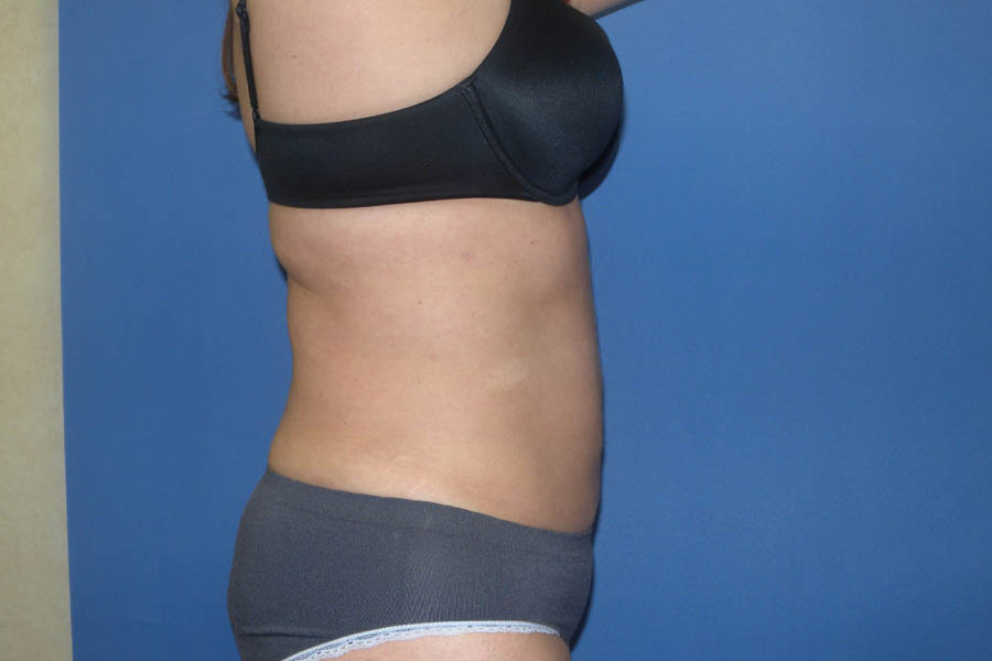Liposuction case #4618