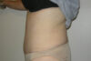 Mommy Makeover case #5506
