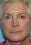 Neck Lift case #5070
