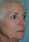 Neck Lift case #5070