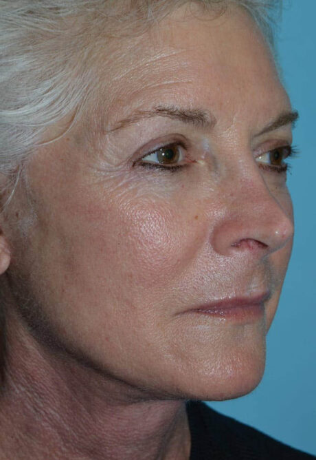 Neck Lift case #5070