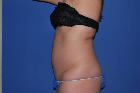 Liposuction case #4618