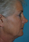 Neck Lift case #5070