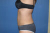 Liposuction case #4618