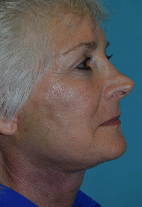 Neck Lift case #5070