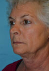 Neck Lift case #5070