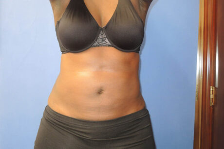 Liposuction case #4629