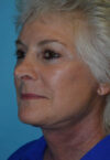 Neck Lift case #5070
