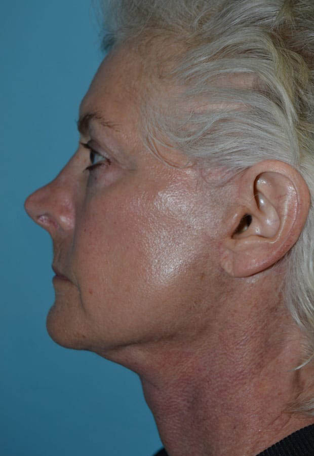 Neck Lift case #5070