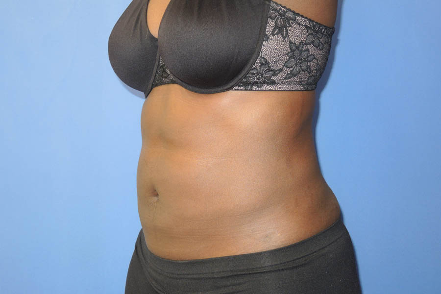Liposuction case #4629