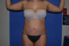 Mommy Makeover case #5495