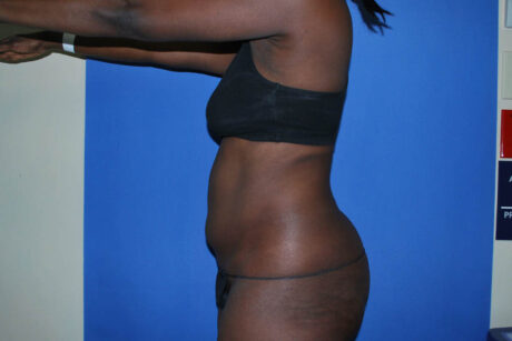 Liposuction case #4629