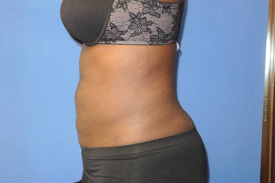 Liposuction case #4629