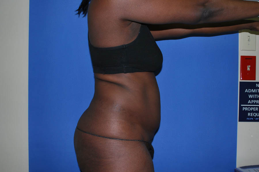 Liposuction case #4629