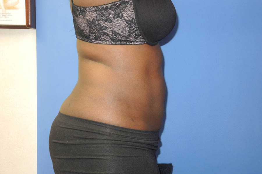 Liposuction case #4629
