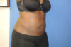 Liposuction case #4629