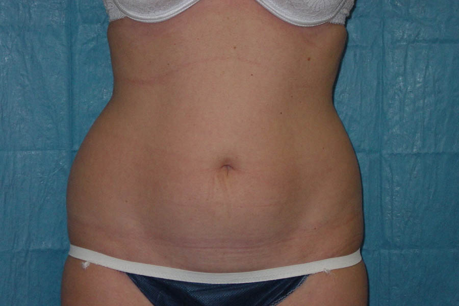 Liposuction case #4640