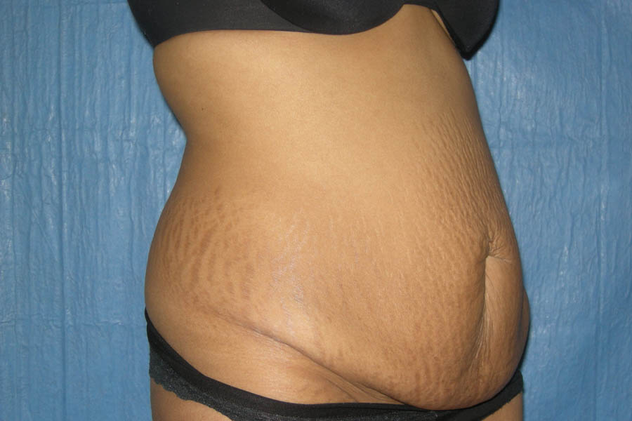 Mommy Makeover case #5495