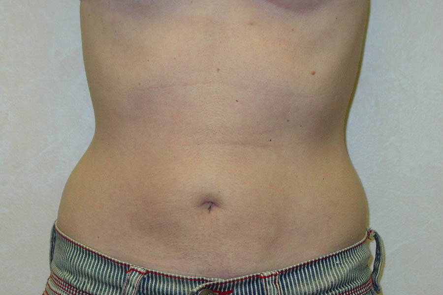 Liposuction case #4640