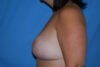 Breast Reduction case #4164