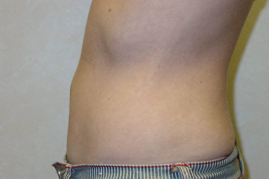 Liposuction case #4640