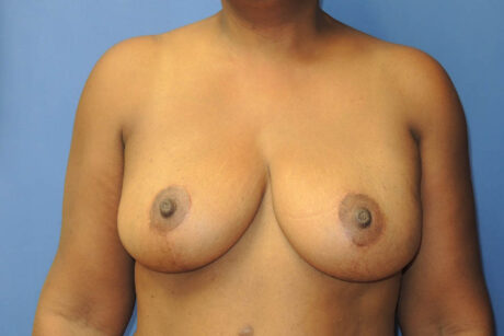 Breast Reduction case #4171
