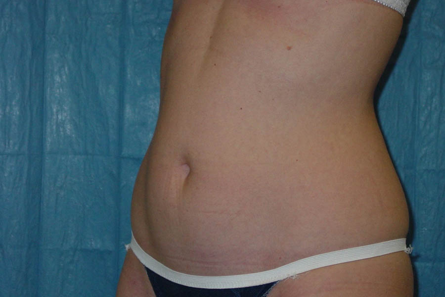 Liposuction case #4640