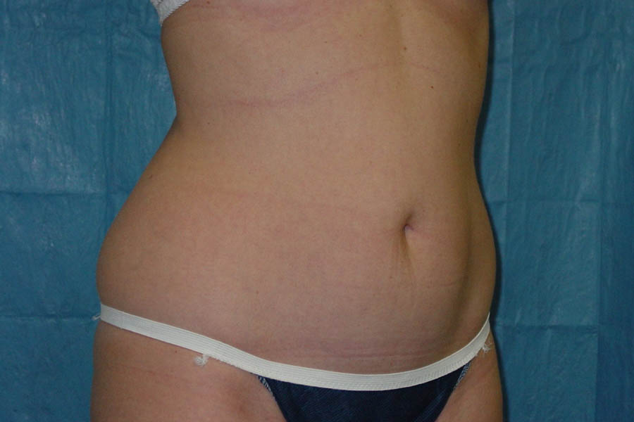 Liposuction case #4640