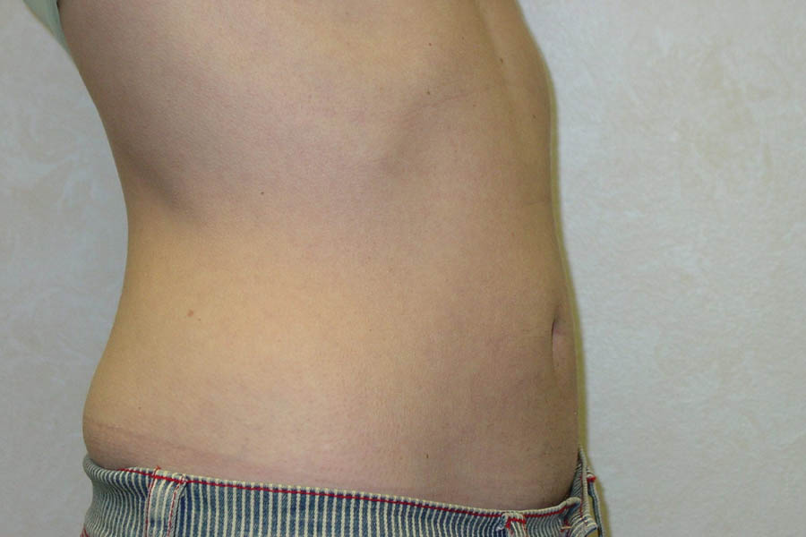 Liposuction case #4640