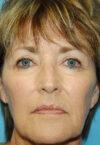 Neck Lift case #5115
