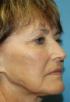 Neck Lift case #5115