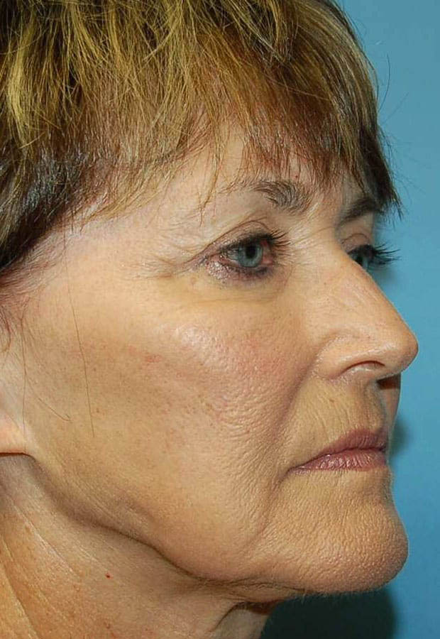 Neck Lift case #5115