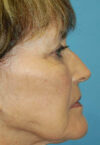 Neck Lift case #5115