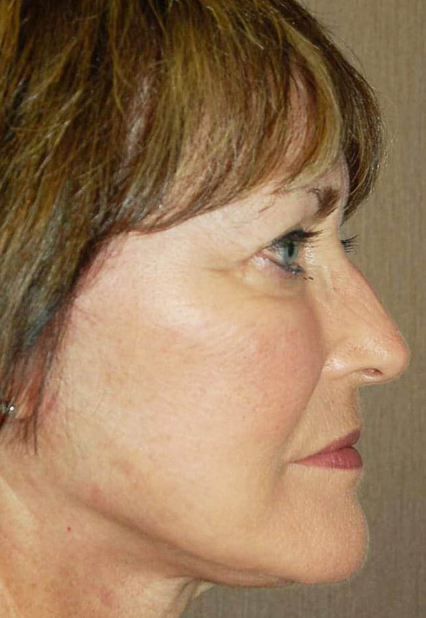 Neck Lift case #5115