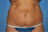 Mommy Makeover case #4667