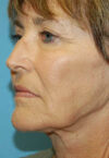 Neck Lift case #5115